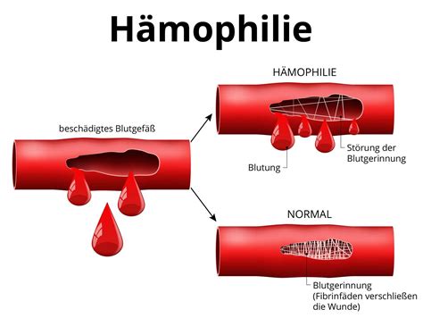 hämophilie a behandlung